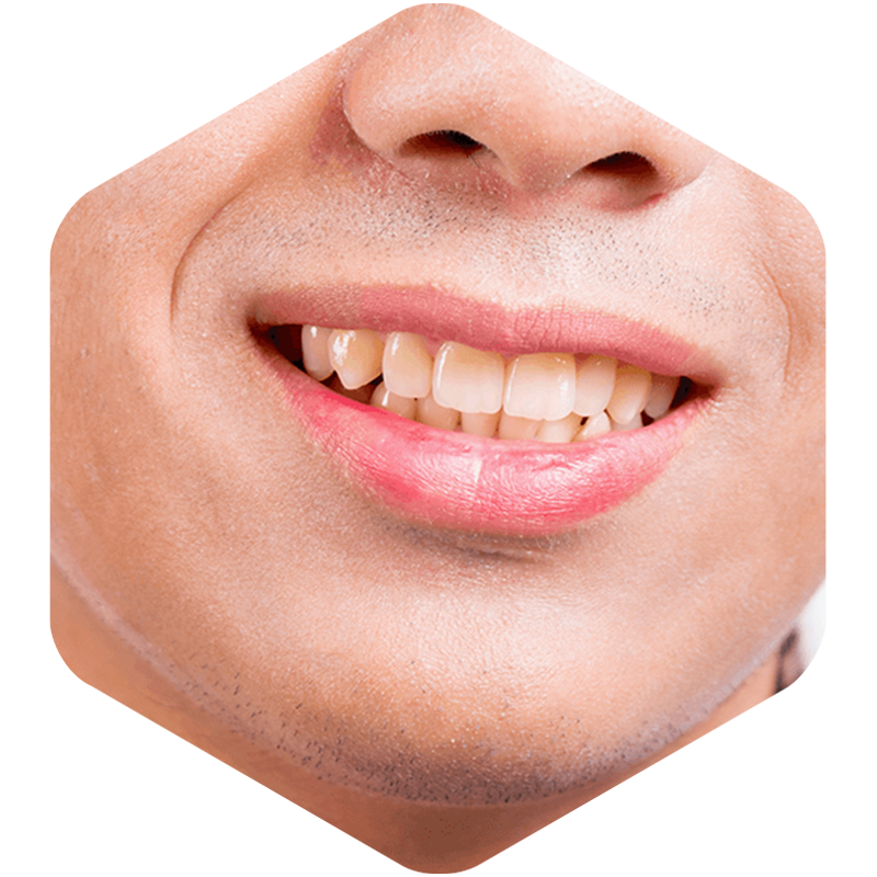 Smile with stained teeth